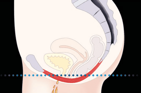 Vaginal rejuvenation treatment illustration at Cannelle Skin Clinic.