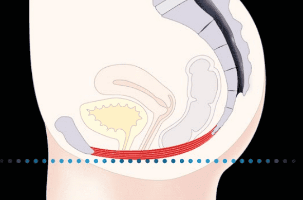 Illustration of vaginal rejuvenation procedure showing internal anatomy and treatment area.