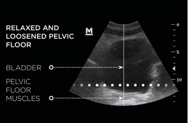 Ultrasound image showing a relaxed and loosened pelvic floor with bladder and pelvic floor muscles l.