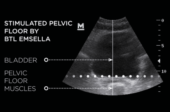 Ultrasound image showing stimulated pelvic floor muscles for pelvic health assessment.