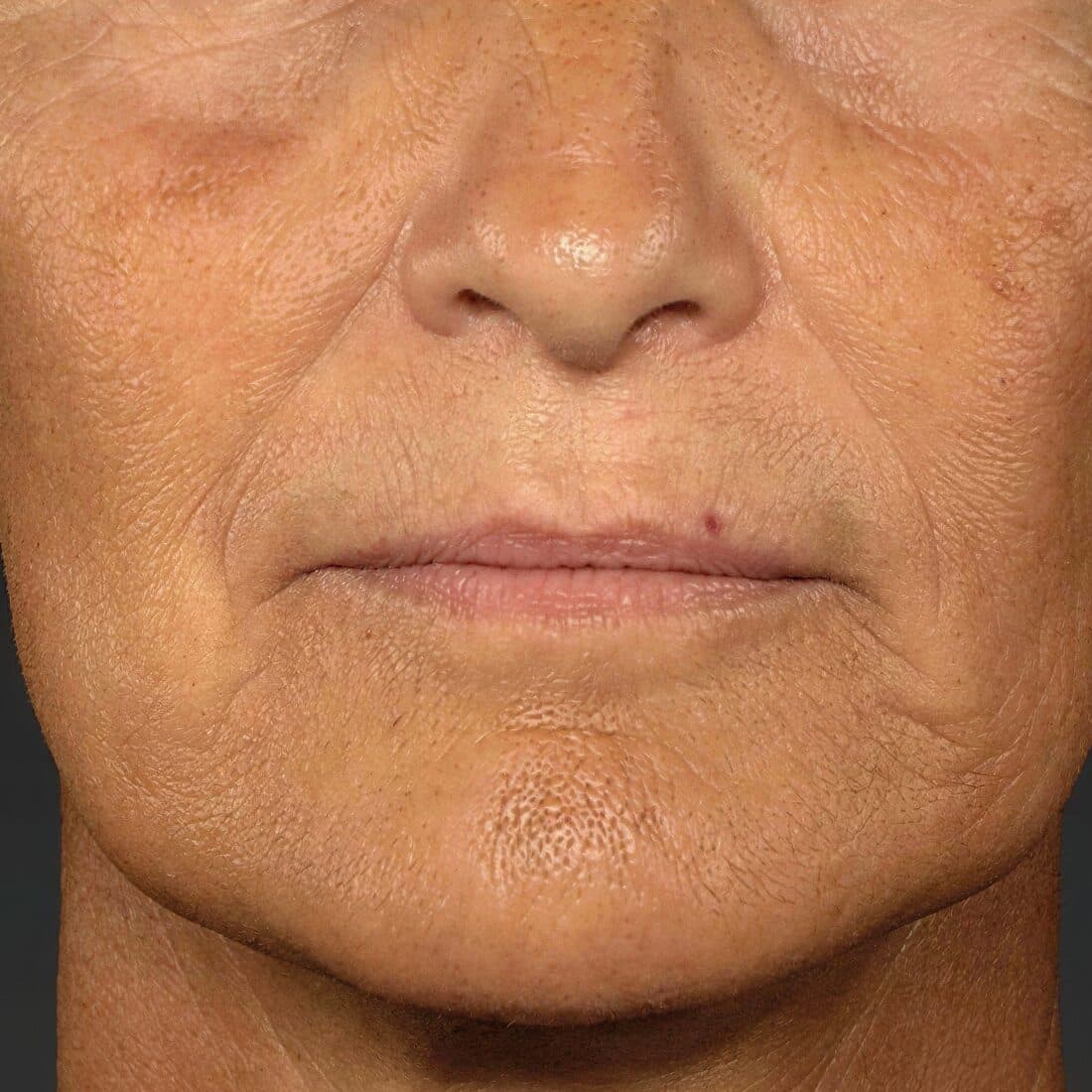 Close-up of mature woman's face showing skin texture before treatment at Cannelle Skin Clinic.