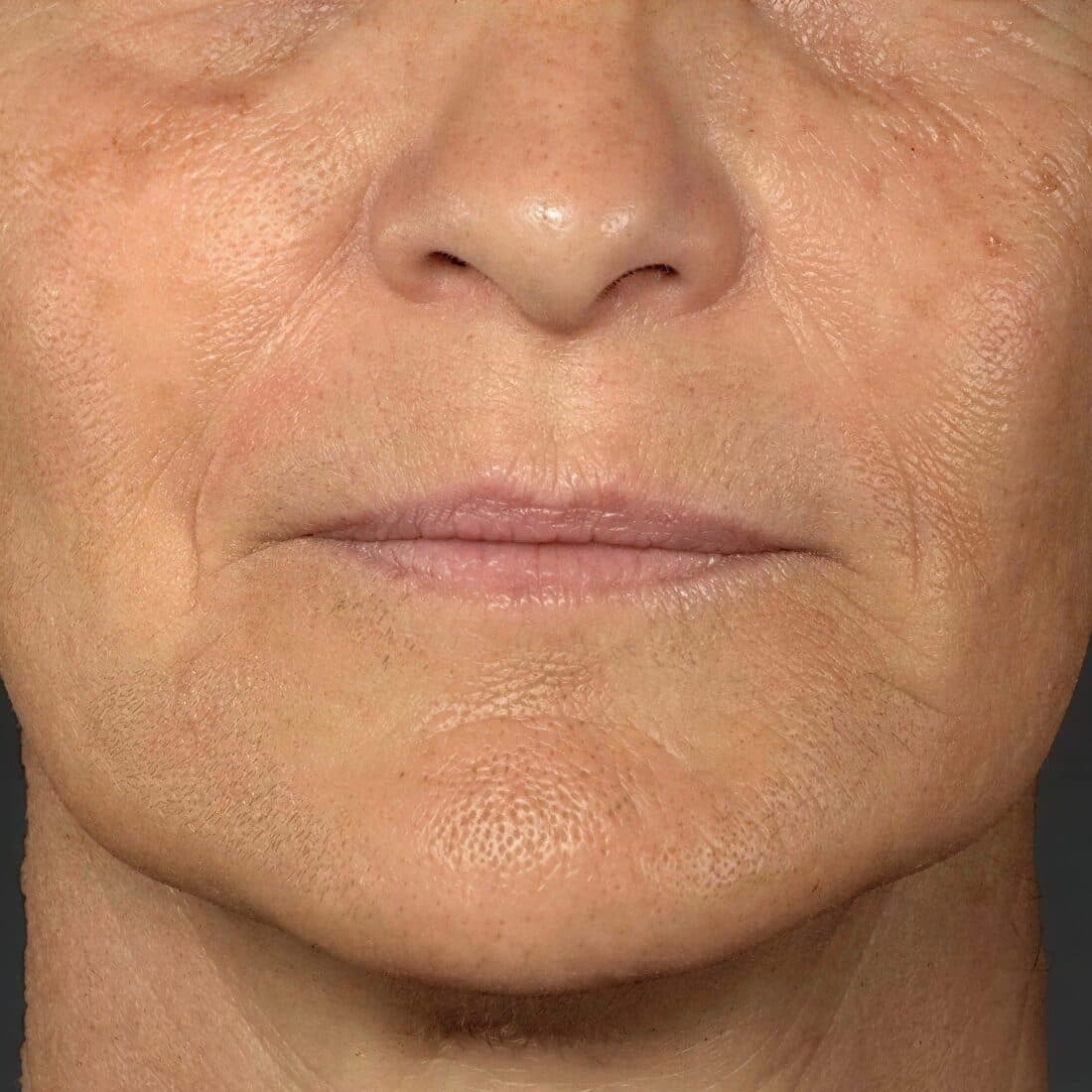 Close-up of mature woman's face showing skin rejuvenation results at Cannelle Skin Clinic.