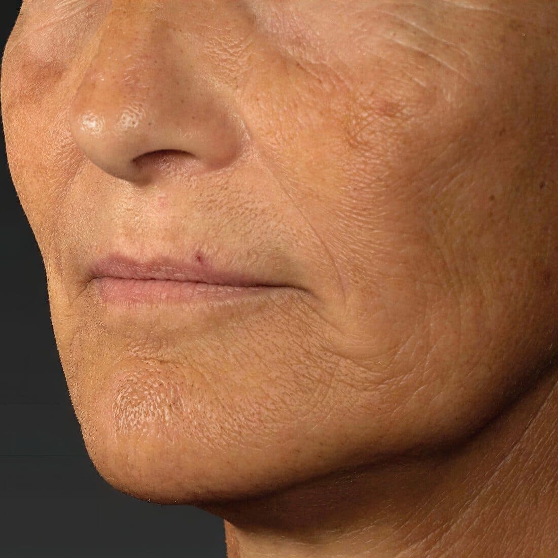 Close-up of mature woman's face showing skin improvement after treatment.