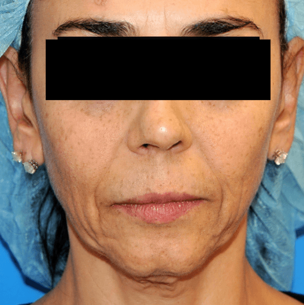 Woman receiving skin treatment for anti-ageing and pigmentation at Cannelle Skin Clinic.
