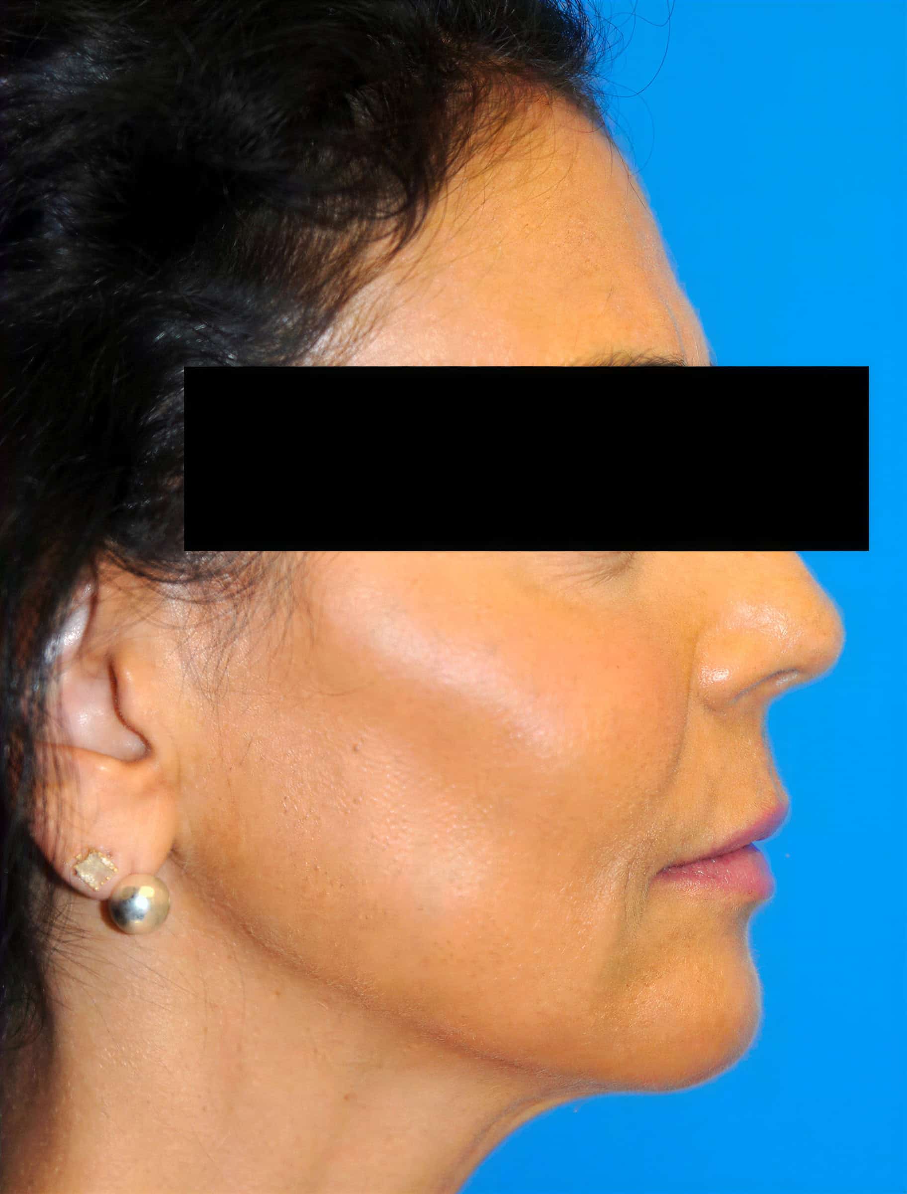 Skin rejuvenation treatment for youthful, radiant skin at Cannelle Skin Clinic.
