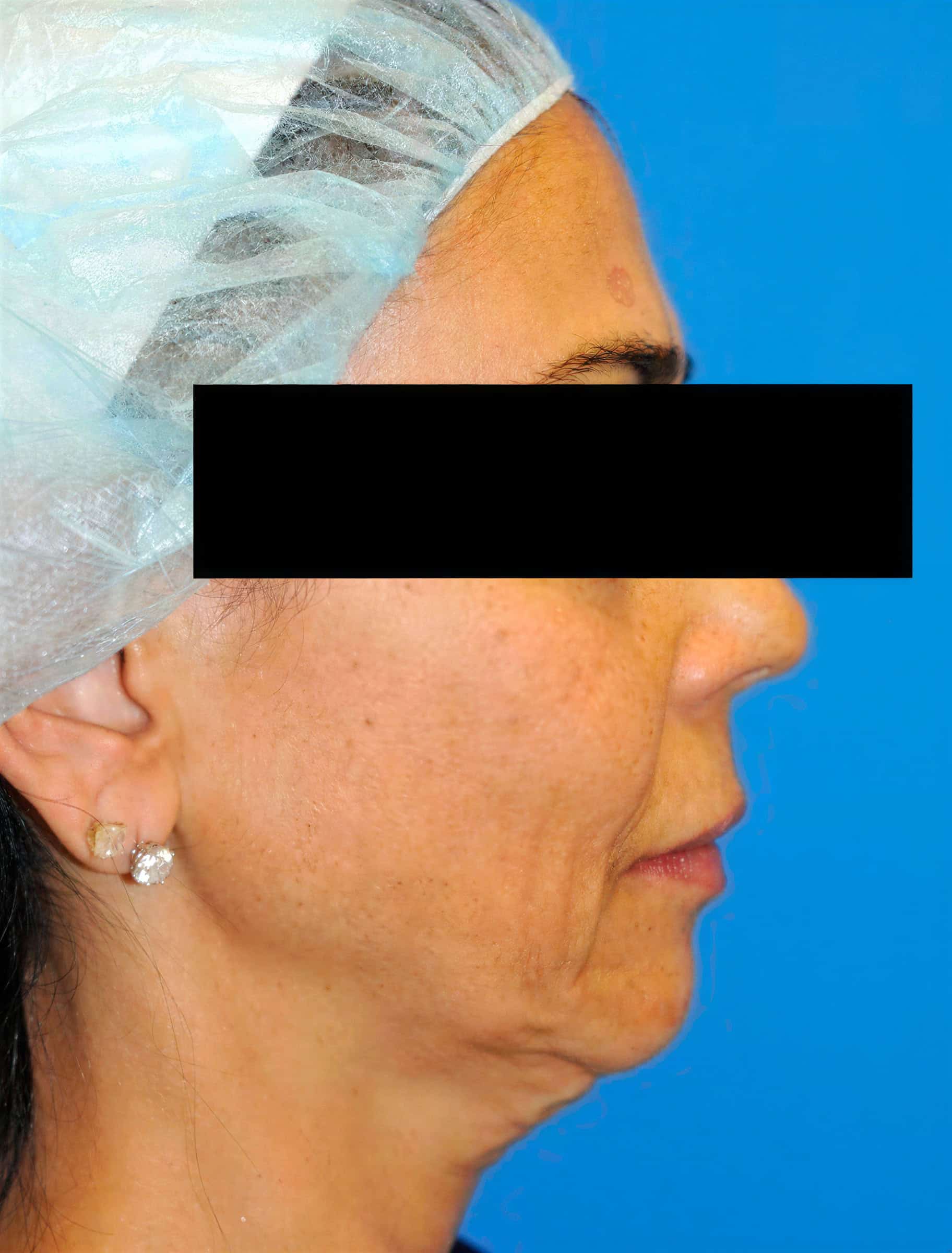 Rejuvenating facial skin treatment for improved texture and appearance.