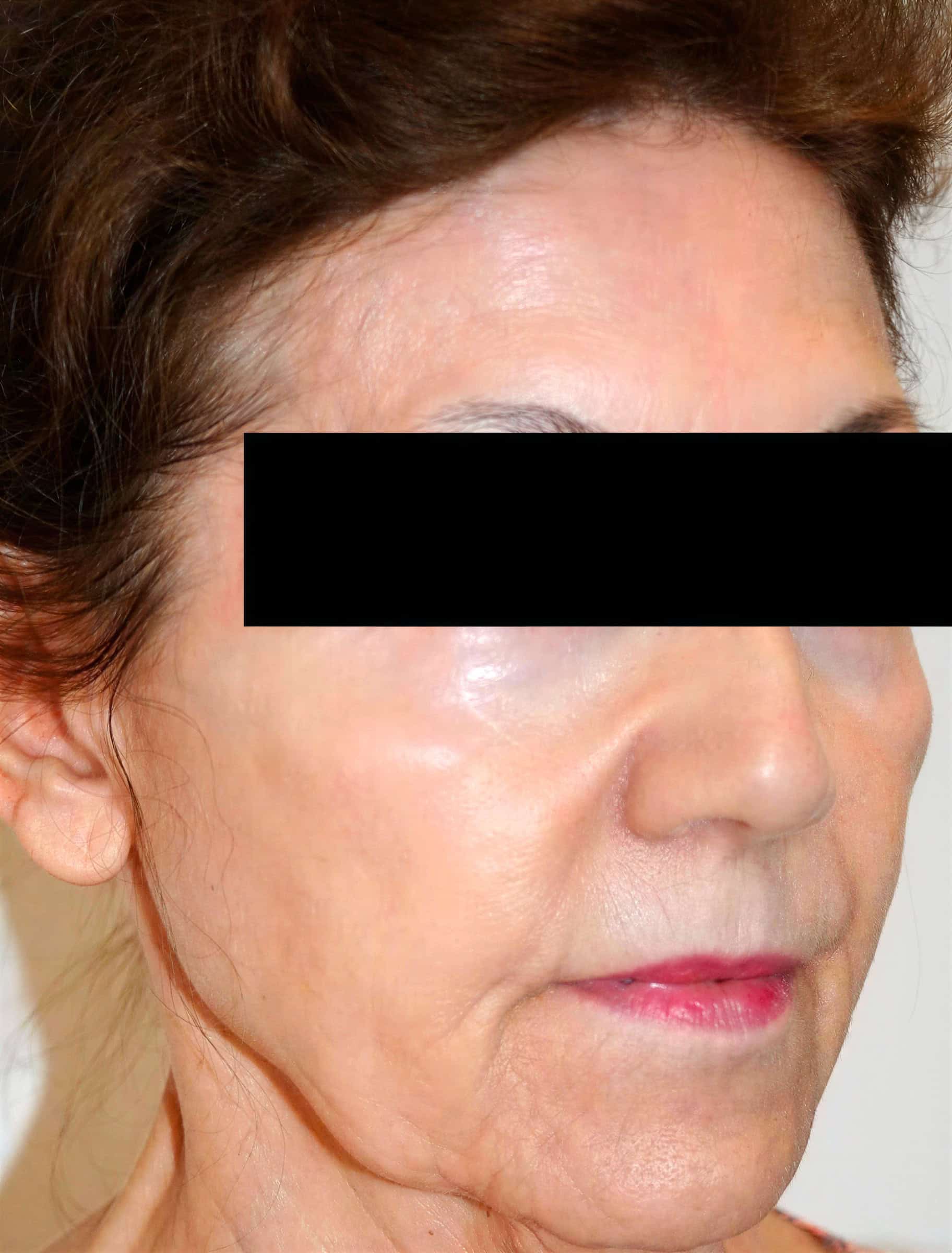 Close-up of mature woman's face showing skin before treatment at Cannelle Skin Clinic.