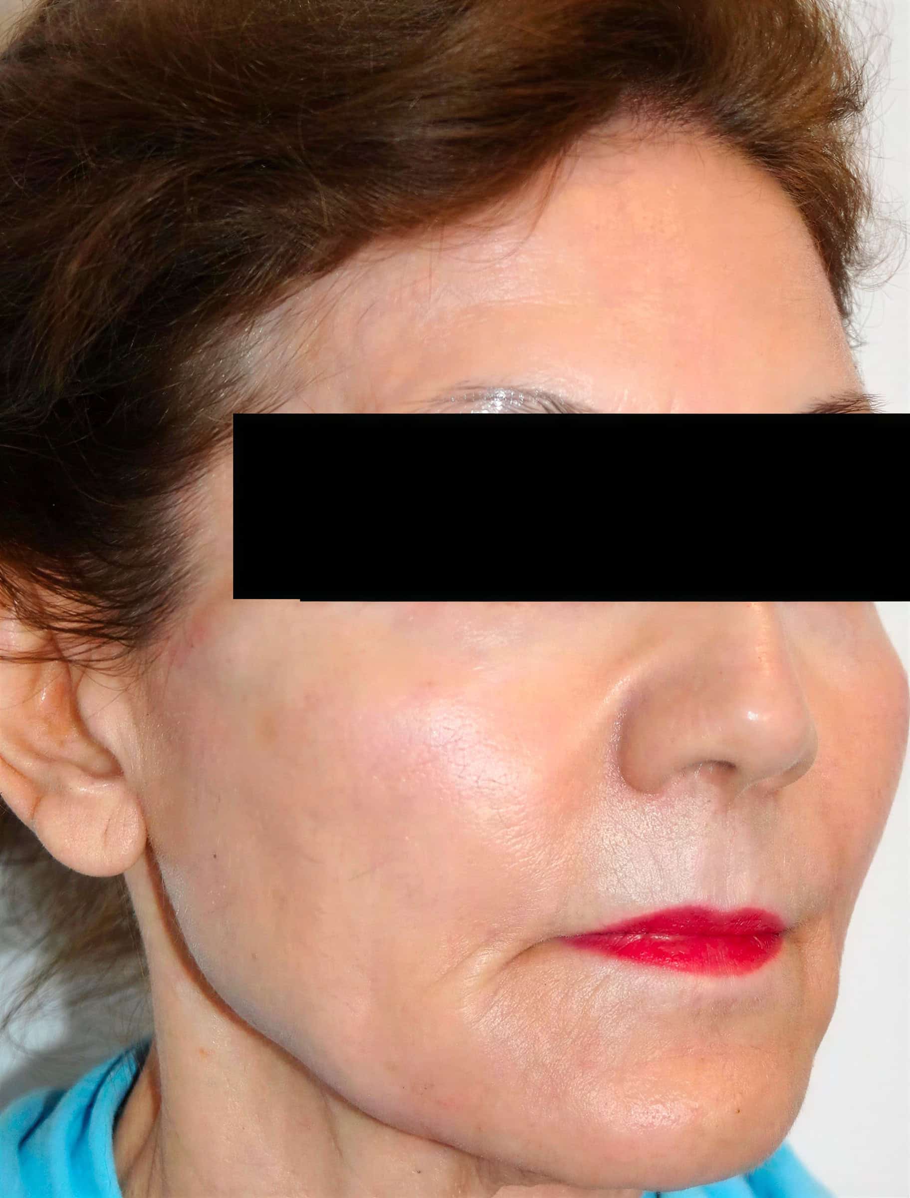 Woman receiving skin rejuvenation treatment at Cannelle Skin Clinic, London.