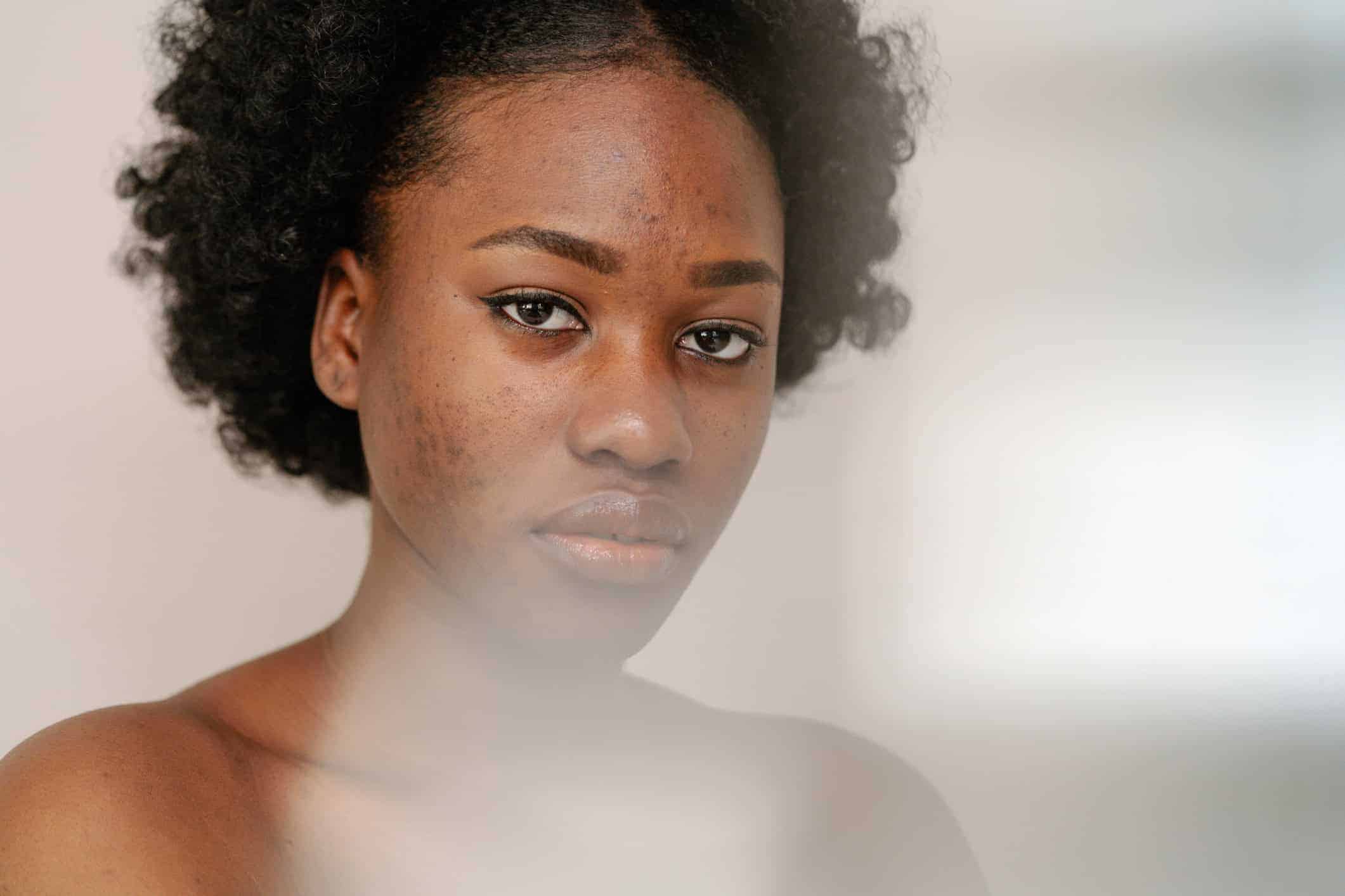 Acne Scarring Treatment in London