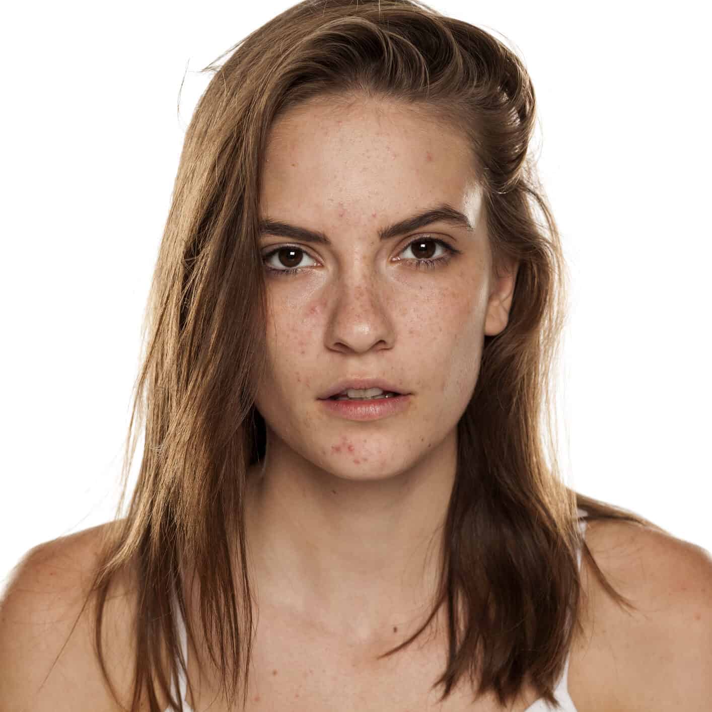 What Acne Scarring Is and Why It Stays
