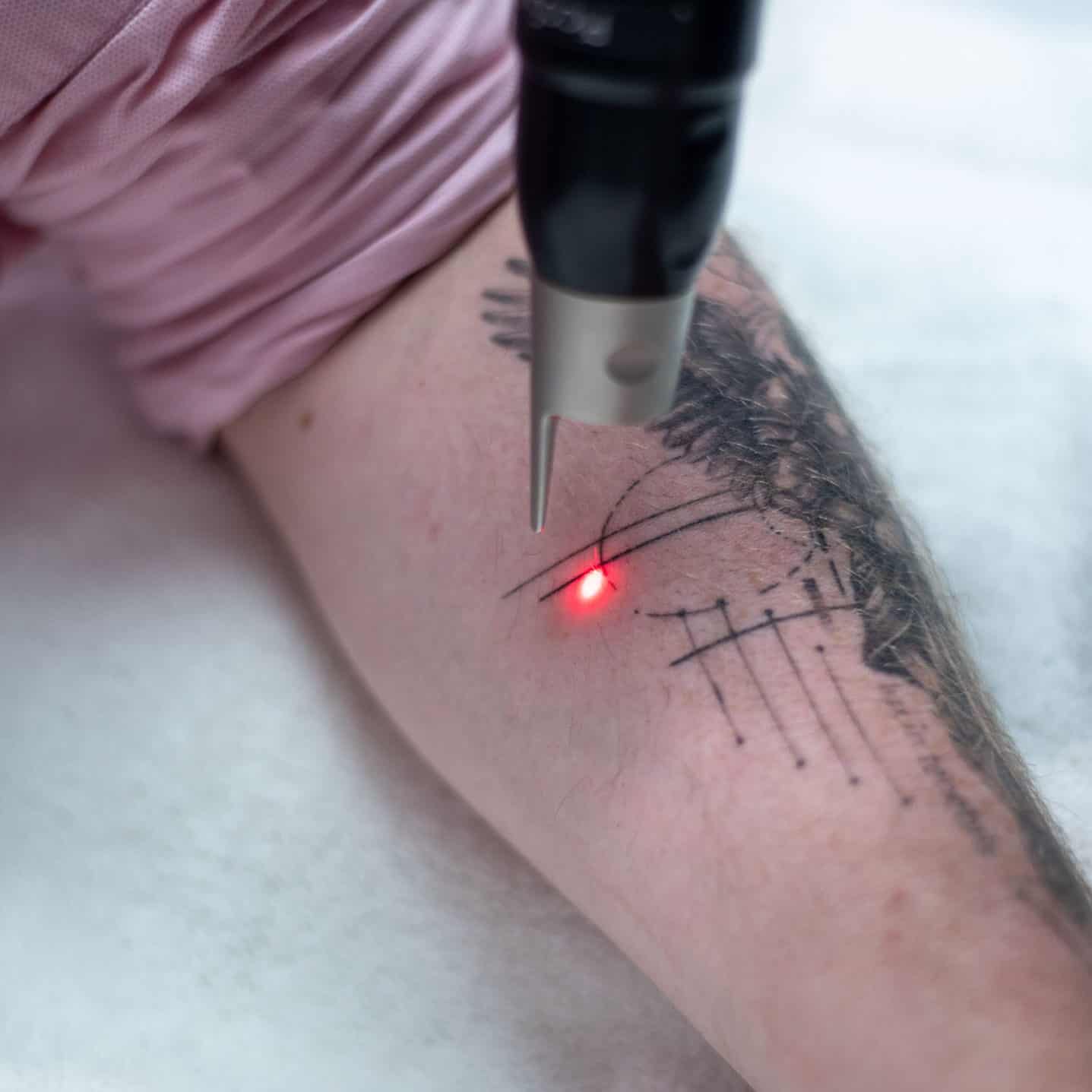 PicoSure laser handpiece treating a black ink tattoo on a forearm