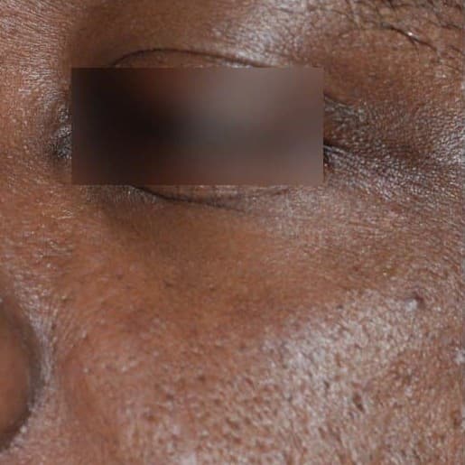 Smoother under-eye skin on deeply pigmented skin after a customised UltraClear treatment