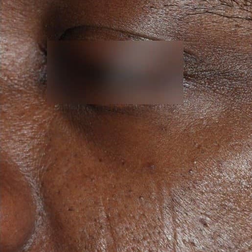 Under-eye lines and skin texture on deeply pigmented skin before UltraClear treatment