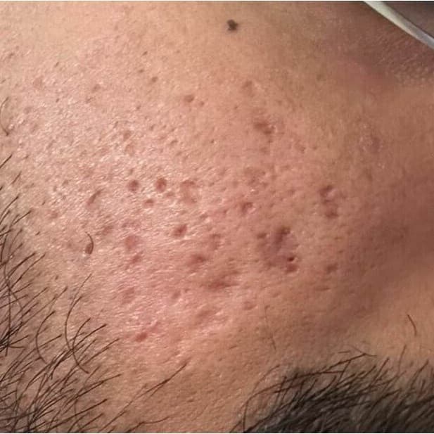 Close-up of the same cheek with shallower acne scars after UltraClear with Laser-Coring