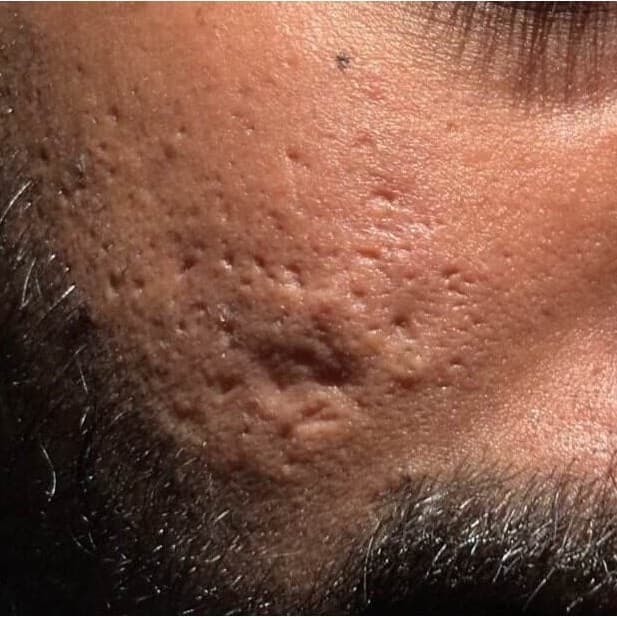 Close-up of rolling and pitted acne scars on the cheek before UltraClear with Laser-Coring