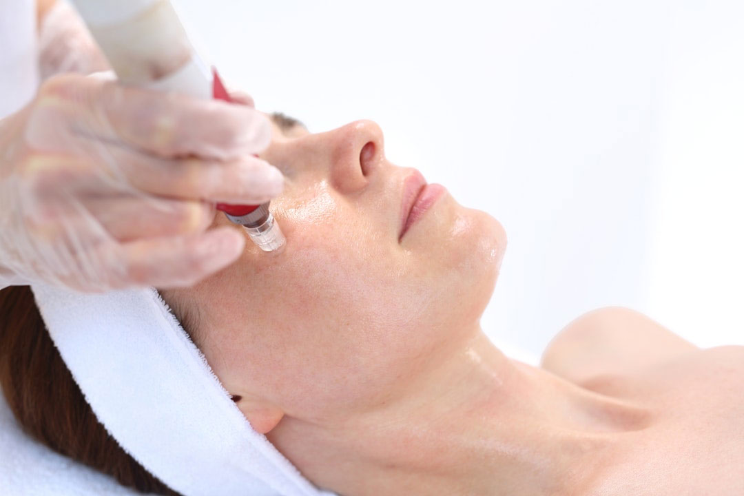microneedling for wrinkles