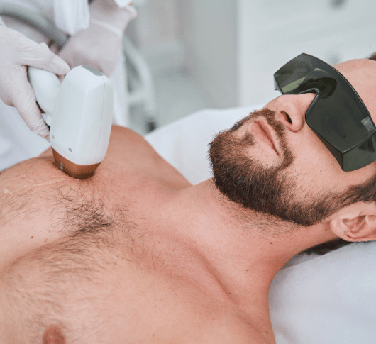 Chest hair removal on a man