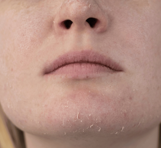 Dry Skin on chin