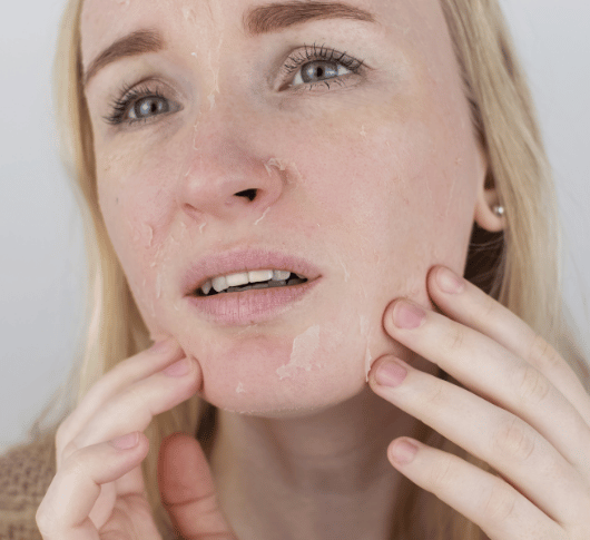 Dry Skin on face
