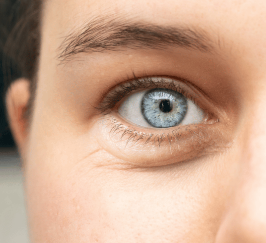 Eye bag under blue eyes