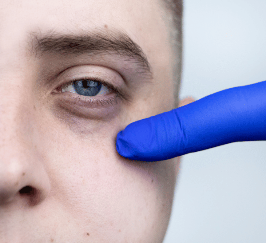 Eye bag under left eye
