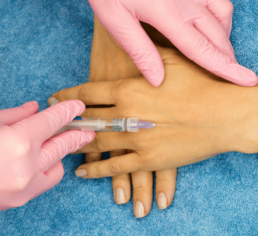 Injecting Radiesse into hands for rejuvenation