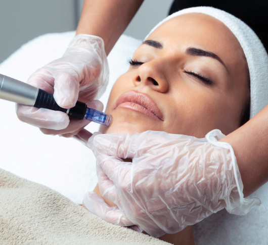 Microneedling chin