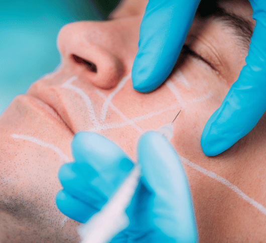 Man having radiesse filler