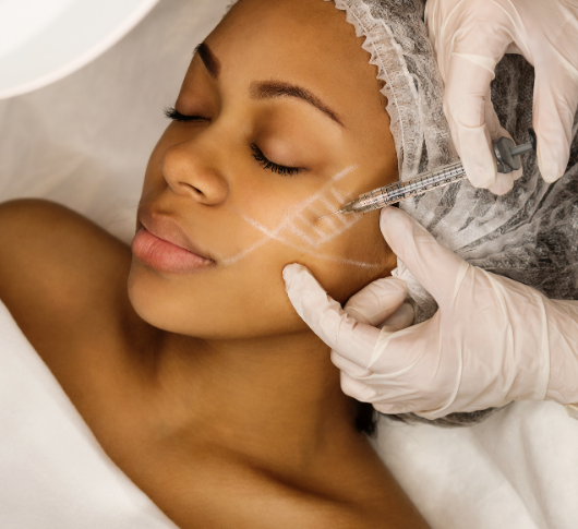 Woman undergoing polynucleotides treatment