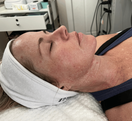 a woman having treatment for pigmentation