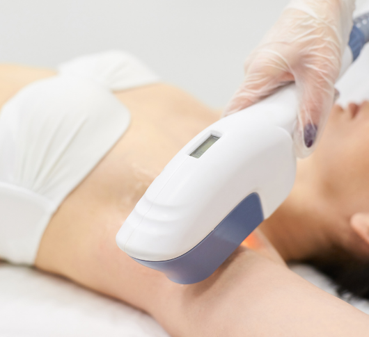 Hair removal laser on female underarm skin